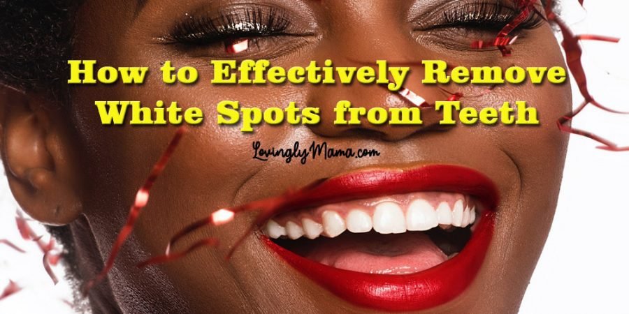 remove white spots on teeth - Bacolod dentist - cosmetic dentist - dental surgeon - natural ways to whiten teeth - teeth whitening